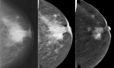 A 75-year-old woman with a palpable mass in her left breast. Postoperative result shows a 6-cm invasive mucinous carcinoma. Images acquired on an amorphous silicon-based full-field digital mammography prototype (Senographe DS, GE Healthcare). The product (SenoBright) has now been cleared by the U.S. Food and Drug Administration for additional workup of inconclusive mammography and ultrasound. Left images: Analog scanned mammography. Middle images: Low-energy image of contrast-enhanced spectral mammography (CESM). Right images: Recombined images of CESM. All images courtesy of Dr. Eva Maria Fallenberg.