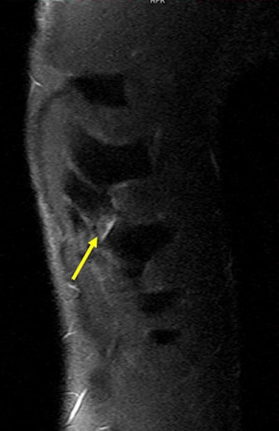 A 26-year-old rugby player with a left-sided thoracic injury. Oblique coronal MR image (short tau inversion-recovery sequence) shows a chondral fracture of the eighth rib. Yellow arrow points to the site of fracture, where a small amount of fluid accumulation is depicted as hyperintensity. Image courtesy of Dr. Daichi Hayashi, PhD.