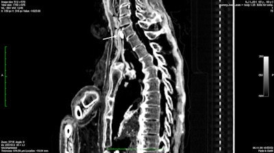 CT revealed a serious wound in the throat of Ramesses III's mummy, directly under the larynx. Copyright: A. Zink.