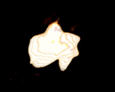 Left: 3D reconstruction of the mummy of Ramses III. Right: The researchers found a flat, irregular, foreign object lodged in the right lower rim of the mummy's wound. It was roughly 15 mm in diameter with a high CT density (2200 HU), similar to a semiprecious stone. Reconstruction of this object showed a 'wedjet' (or Horus eye) amulet. The eye of Horus is a magical amulet that served as a metaphor of royal power, protection, and good health in ancient Egypt, they noted. Copyright of both images: A. Zink.