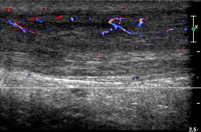 Ultrasound shows thickening of the left Achilles tendon in a 34-year-old man who is a triathlete. Neovascularity is in keeping with Achilles tendonitis. Image courtesy of Dr. Denis Remedios.