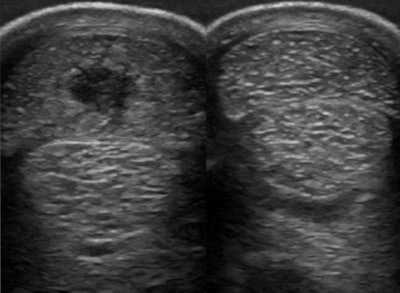 Superficial digital flexor tendon injury; abnormal tendon on the left, normal tendon on the right. Image courtesy of Sarah Boys-Smith.