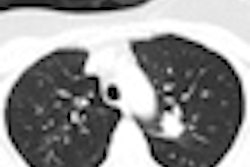 2012 08 22 14 45 18 925 2012 08 23 Ct Lung Screening1 Thumb