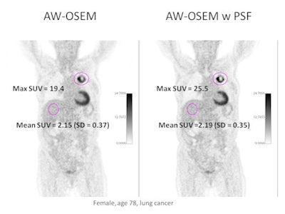 Whole-body PET/CT shows the difference between AW-OSEM (left) and AW-OSEM with PSF (right) and the increase in SUVmax by adding PSF. Image courtesy of Dr. Søren Holm.