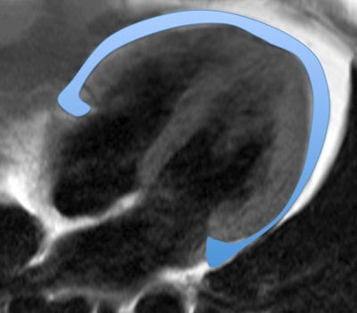 Above, four-chamber view and below, short-axis view of a patient with depression and increased EAT (marked in blue). All images courtesy of Dr. Katja Hüper.