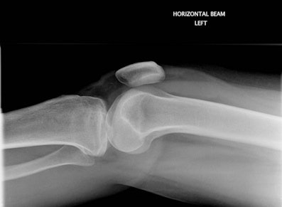 Figure 1B: Tibial plateau fracture with visible lipohemarthrosis was identified on image review. The patient was recalled to A&E for orthopedic intervention several days later.