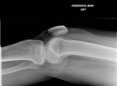 Figure 1B: Tibial plateau fracture with visible lipohemarthrosis was identified on image review. The patient was recalled to A&E for orthopedic intervention several days later.