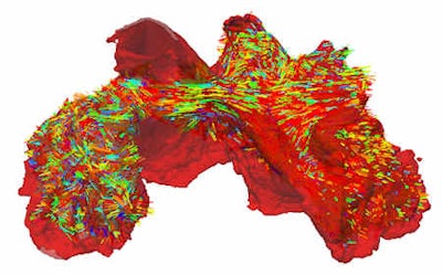 Top: Reconstructed 3D anatomy of the sheep atria with fiber structures (colored lines). Bottom: Simulated erratic electrical excitation waves during AF (cell membrane potentials are color coded from -80 mV [blue] to +30 mV [red]). All images courtesy of Henggui Zhang, PhD.