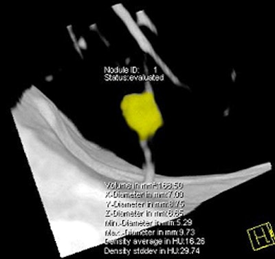 Spiculated nodule at CT