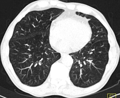 Nodule resolved at follow-up