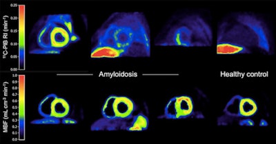 Images of PiB and myocardial blood flow in patients with high, intermediate, and partially increased PiB retention and a healthy control