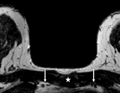 An example of the measurement of the cross-sectional area of the internal mammary vessels in a patient with a right-sided breast lesion of 1.9 cm. With sagittal reconstruction, the manubrium was marked (white star), which appears automatically in the transverse slices. On the transverse slice, using the marker the second intercostal space is recognized and the cross-sectional area of the internal mammary vessels (left and right arrows) can be measured. In this patient, the right internal mammary artery measured 5.21 mm2, compared with the left internal mammary artery of 4.12 mm2. Histopathology showed an invasive ductal carcinoma. Image courtesy of Dr. Robert-Jan Schipper.