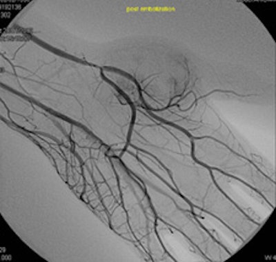 A 16-year-old female presented with a mass in her left hand