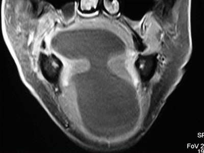 MR images midline cystic lesion in the floor of the mouth