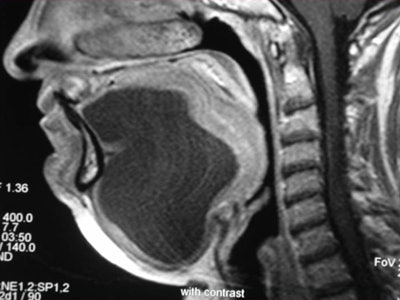 Contrast-enhanced coronal and sagittal T1-weighted images show a large, hourglass-shaped midline cystic lesion in the floor of the mouth splitting the genioglossus muscles. The diagnosis is a dermoid cyst. Images courtesy of Dr. Alexandra Borges.