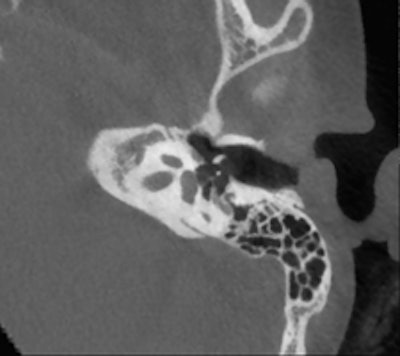 Conebeam CT of a 12-year-old child with conductive hearing loss on the right side