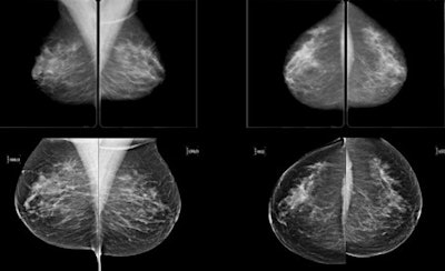 Architectural distortion that was not recalled during screening, but detected on CAD. Top row: Exams that were not recalled during screening: Bottom row: Exams where lesion was detected in a later screening round.