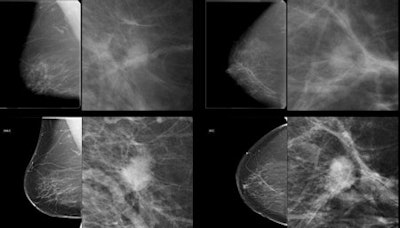 subtle mass not detected during screening