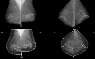 Subtle mass that was not recalled during screening, but detected on CAD. Top row: Exams that were not recalled during screening. Bottom row: Exams where lesion was detected in a later screening round. All images courtesy of Dr. Jaime Melendez.