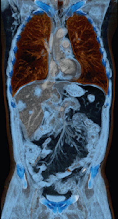 This case of a liver tumor was examined with a Somatom Perspective scanner from Siemens Healthcare. The volume-rendered technique (VRT) image highlights multiple liver lesions and fine details of the mesenteric arteries. Image courtesy of Diagnosezentrum Favoriten, Vienna.