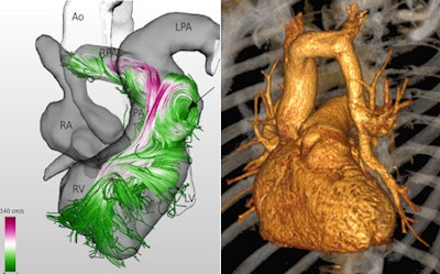 Left: MR 4D flow reconstruction of an adult patient after surgically corrected tetralogy of Fallot demonstrates an aneurysm of the right ventricular outflow tract with pathologic flow pattern (arrow) due to the aneurysm and pulmonary valve regurgitation. RV=right ventricle, LV=left ventricle, RA=right atrium, LPA=left pulmonary artery, RPA=right pulmonary artery, Ao=aorta, PA=pulmonary artery. Adapted from: Born S, Pfeifle M, Markl M, Gutberlet M, Scheuermann G. Visual Analysis of Cardiac 4D MRI Blood Flow Using Line Predicates. IEEE Trans Vis Comput Graph 2012. Right: 3D reconstruction of a multidetector-row CT dataset of a 65-year-old patient with a partially anomalous left pulmonary vein. Images courtesy of Matthias Gutberlet.
