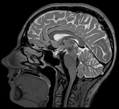 Brain MRI with Siemens Healthcare Magnetom Prism 3-tesla system