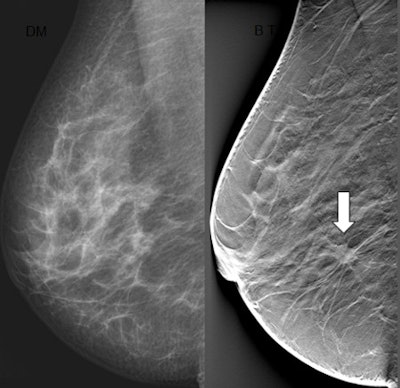 In this screening case, an asymptomatic woman has a tumor that is not discernible on digital mammography (left), but appears as a clearly visible spiculated lesion on digital breast tomosynthesis (white arrow), which shows the slice where the lesion is in focus. The lesion is a 13-mm invasive ductal carcinoma, grade 2. Images courtesy of Dr. Sophia Zackrisson.