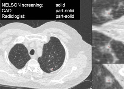 Axial slice through the center of the nodule, and on the right are three zoomed-in views in axial, sagittal, and coronal directions. This nodule was classified as solid in the screening database, but both the CAD and the thoracic radiologist judged it to be a part-solid nodule.