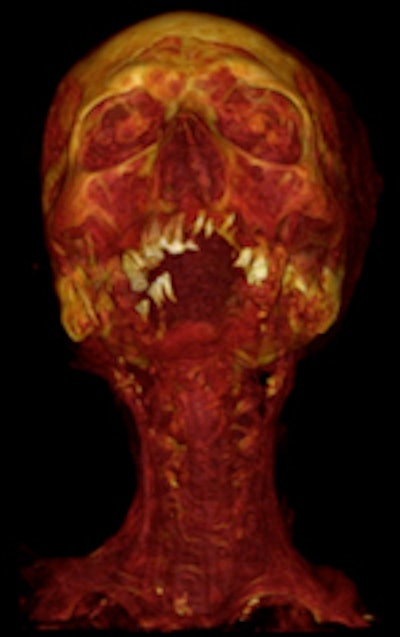 CT reconstruction showing carotid artery disease