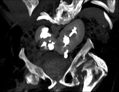 Reconstructed coronal maximum intensity projection CT image of 33-year-old male with spina bifida