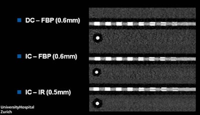 Phantom coronary CT angiography images with a slice thickness of 0.5 mm reconstructed with iterative reconstruction obtained by the integrated circuit detector improved measurement accuracy by the greatest degree. A 60% stenosis at filtered back projection appears to occupy the entire lumen, with the conventional detector, while demonstrating nonstenosed lumen using the new detector and even more with the addition of iterative reconstruction. All images courtesy of Dr. Fabian Morsbach.
