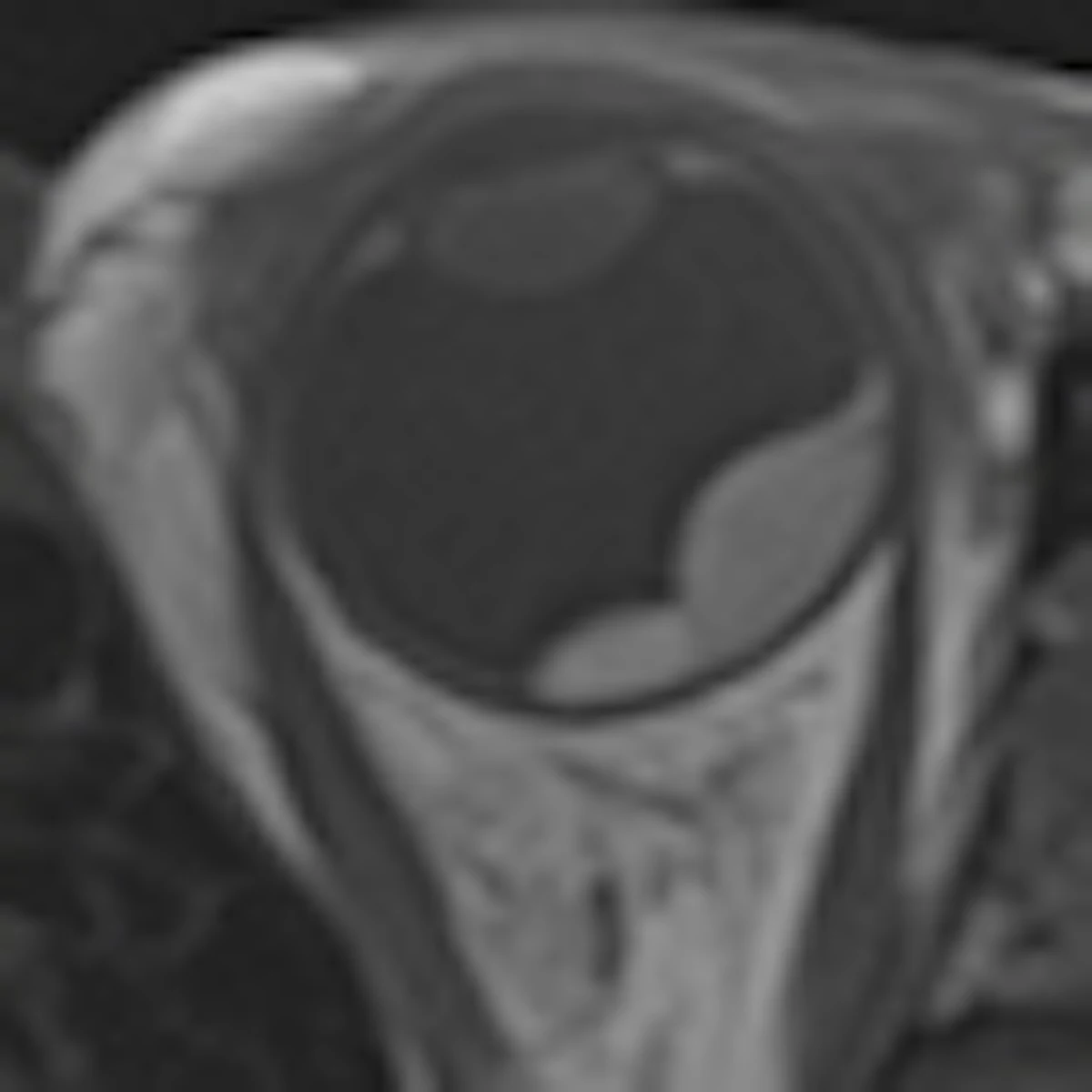 Dwi Mri Assists Proton Beam Therapy For Ocular Melanoma Auntminnieeurope