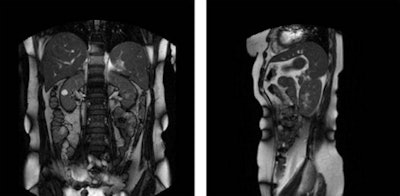 Left: Coronal and Right: sagittal time frame in 2D cine MRI. Image reproduced with permission from IOP Publishing.