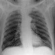 2012 02 15 18 04 43 278 2012 02 17 Chest Radiography Thumb