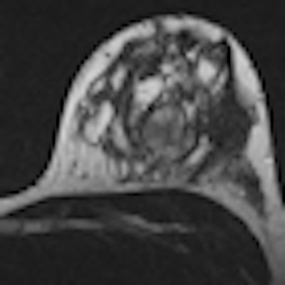 2012 04 04 11 45 17 882 2012 04 05 Breast Mri