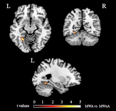 Areas showing significant GM volume differences (p < 0.05, familywise error corrected) between migraine patients with (MWA) and without (MWoA) aura, superimposed on a high-resolution T1-weighted template. MWA vs. MWoA: GM volume increase of the left fusiform gyrus.