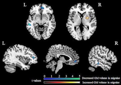 Areas showing significant gray-matter (GM) volume differences (p < 0.001, uncorrected) between migraine patients and healthy controls, superimposed on a high-resolution T1-weighted template. Areas with reduced gray-matter volume in migraine patients versus controls are shown in blue; areas with increased gray-matter volume in migraine patients versus controls are shown in red. All images courtesy of Dr. Massimo Filippi.