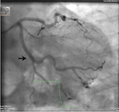 A 64-year-old patient with carotid stenosis. Top left: Coronary CT angiography image. White arrow points to a soft plaque in the midcircumflex artery, with stenosis of the lumen. Calcium score was 64. Top right: Short-axis image of the adenosine perfusion MRI examination. White arrow points to a perfusion defect in the posterolateral wall, during stress. The perfusion defect was not present in the rest series, thus indicating inducible ischemia. Bottom left: Invasive coronary angiography image of the left coronary arteries. Black arrow points to a significant stenosis, corresponding with the location seen on CT. Bottom right: Invasive coronary angiography image after intervention. Good results were achieved after percutaneous coronary intervention with stent placement. All images courtesy of Drs. Rozemarijn Vliegenthart and Martijn den Dekker.