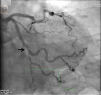Invasive coronary angiography