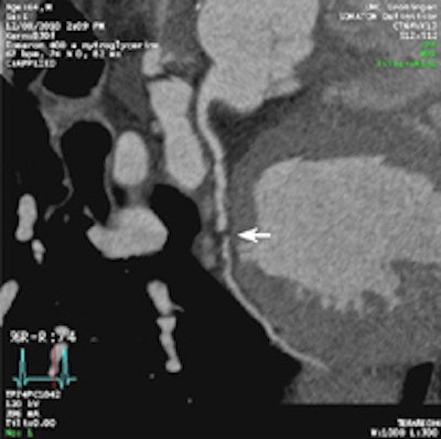 Coronary CT angiography