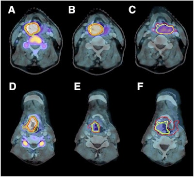 FLT-PET/CT images of laryngeal carcinoma before therapy (A and D), in second week of therapy (B and E), and in fourth week of therapy (C and F). Images A, B, and C show a slow decrease in FLT uptake, while D, E, and F show a fast decrease in FLT uptake. Image courtesy of JNM.