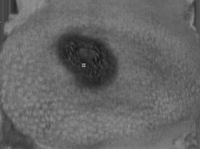 Automated breast volume scan acquired with the Acuson S2000 ABVS1 machine. The skin line submillimeter image shows the coronal view of the breast, which is not available using conventional, handheld ultrasound. Image courtesy of Siemens Healthcare.
