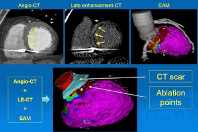 Coronary CTA images (left) show myocardium, and myocardial scar substrate in late-enhancing multidetector CT images (center), and electroanatomic mapping (EAM) image (right). Three image datasets combined (below) show myocardial scar guiding determination of ablation points. Images courtesy of Dr. Caterina Colantoni and Dr. Antonio Esposito.