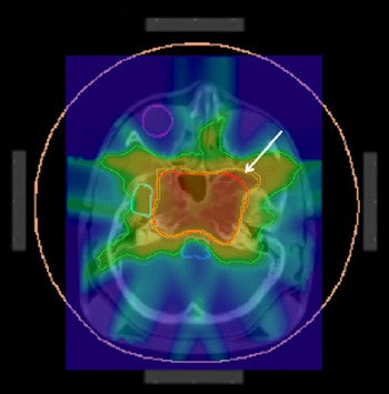ImageSlice of the original dose. Isolines correspond to the 50%, 90% and 95% volumes of the reference dose (set at 57.6 Gy). The marked area is the identified hot spot. All images courtesy of Philipp SĂĽss, PhD.
