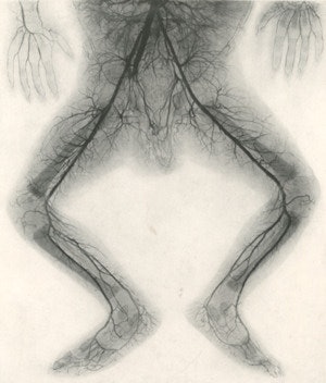 Figure 3 (left): Systemic vessels of the superior half of the body (Orrin 1920). Right: Figure 4 (right): Systemic vessels of the inferior half of the body (Orrin 1920).