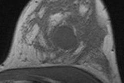 2013 04 24 16 08 58 948 Baltzer Breast Mr Iexam 200