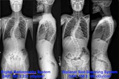 Neutral standing radiographs of 18-year-old man demonstrates dextroscoliosis at the thoracic level (Cobb angle: 65°) and levoscoliosis at the lumbar level (Cobb angle: 55°). Standard digital radiographs on the left side were obtained at the first consultation. Biplanar radiographs on the right side were requested six weeks later prior to surgery. Additional secondary 3D reconstructions of the biplanar radiographs were provided to the spine surgeon to plan the operation. All images courtesy of Dr. Tobias Dietrich.