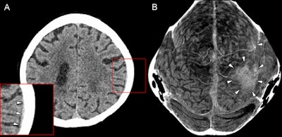 Figure A is a transverse section of a cranial CT image from a 58-year-old woman with a thin subdural hematoma (arrowheads) in the left parietal and temporal region. Lower left corner shows magnification. Figure B is a thin curved MIP of the skull vault. Arrowheads point to the large hematoma, while the single arrow in the left frontal region refers to a smaller hematoma. Image courtesy of Radiology.