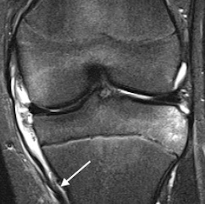 Distal rupture of the medial collateral ligament (arrow) on coronal short-tau inversion recovery of a 15-year-old boy. All images courtesy of Drs. Jacob Jaremko and Zachary Guenther.