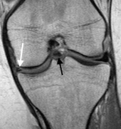 Bucket-handle tear of the medial meniscus